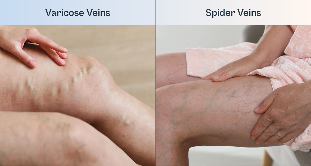 Comparison photo between varicose veins and spider veins, both on the thigh.