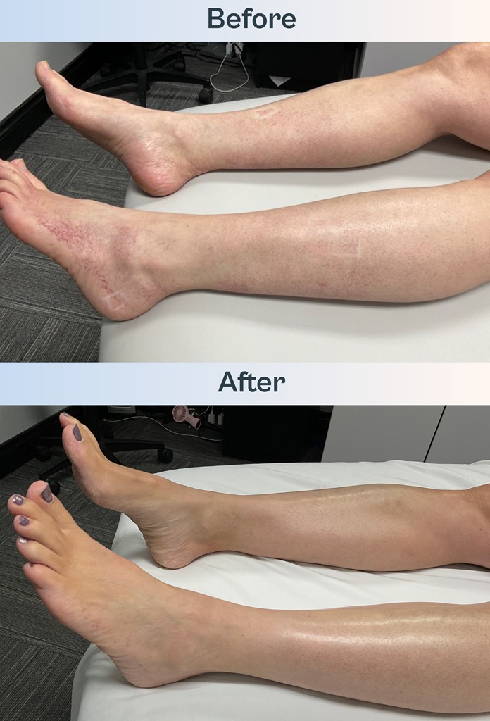 A before and after image of a patient's leg and feet before and after they received spider vein treatment with Southwest Michigan Dermatology.