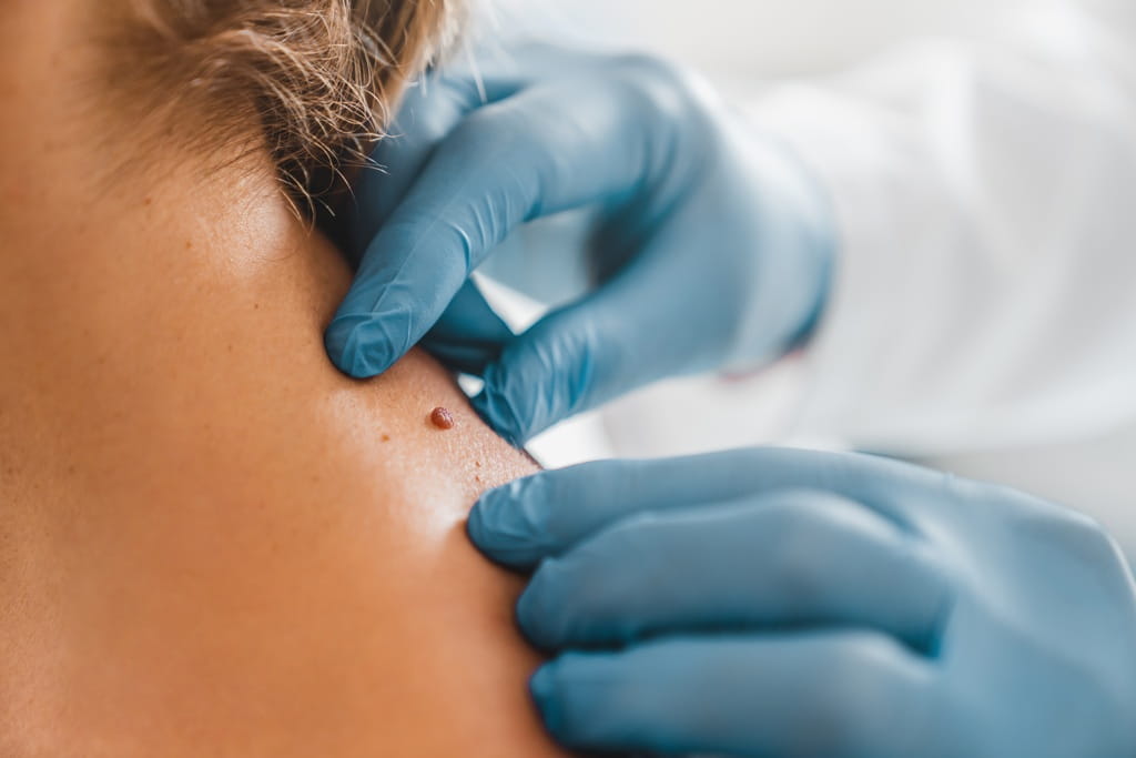 Close up of a mole being examined by a doctor.
